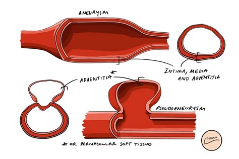 ventricular aneurysm vs pseudoaneurysm.